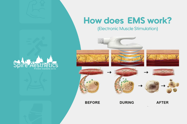 EMS treatment for post pregnancy weight loss treatment Datchet