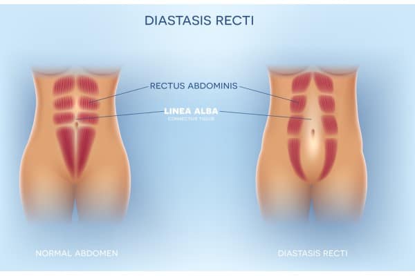 How Does Non-Surgical Treatment Help With Loose Skin, Weak Abdominal Muscles and Post-Pregnancy Changes Datchet?