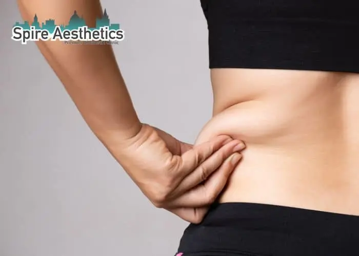 Image of woman pinching fat on their hips Datchet. Fat Freezing treatment