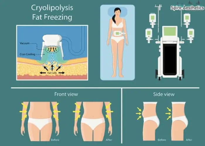 Fat freezing treatment Datchet benefits for competitions to remove stubborn fat deposits.
