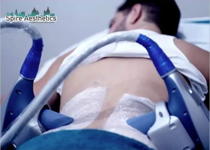 Man having fat freezing treatment done on love handles before a competitions Datchet to create a sculpted look.