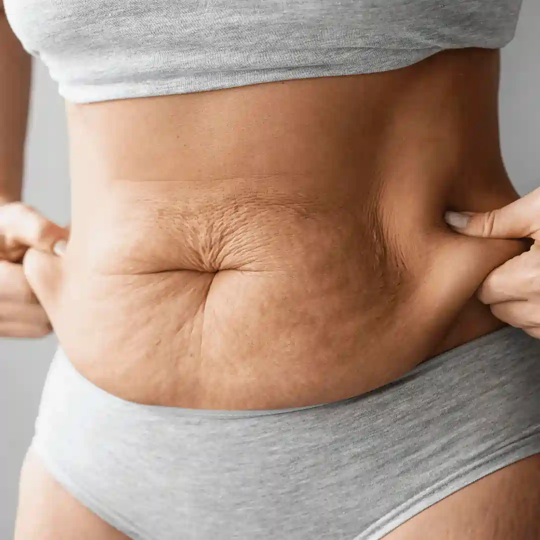 Is It Normal to Have Loose Skin After Pregnancy Datchet?