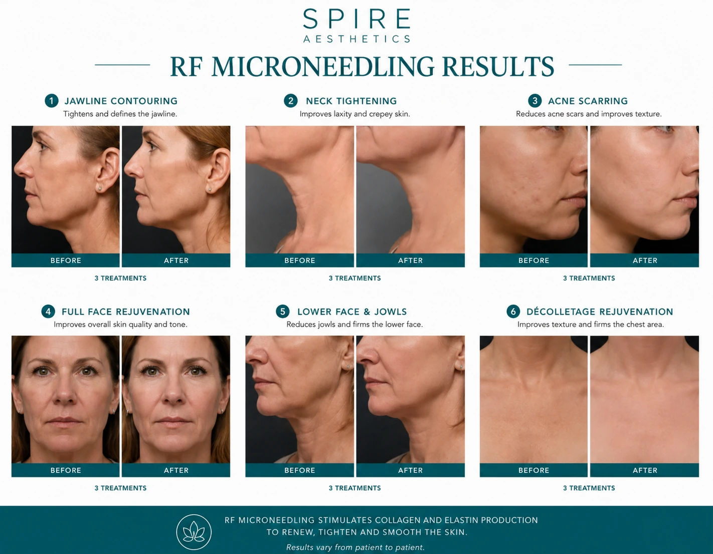 RF Microneedling Skin tightening Datchet results