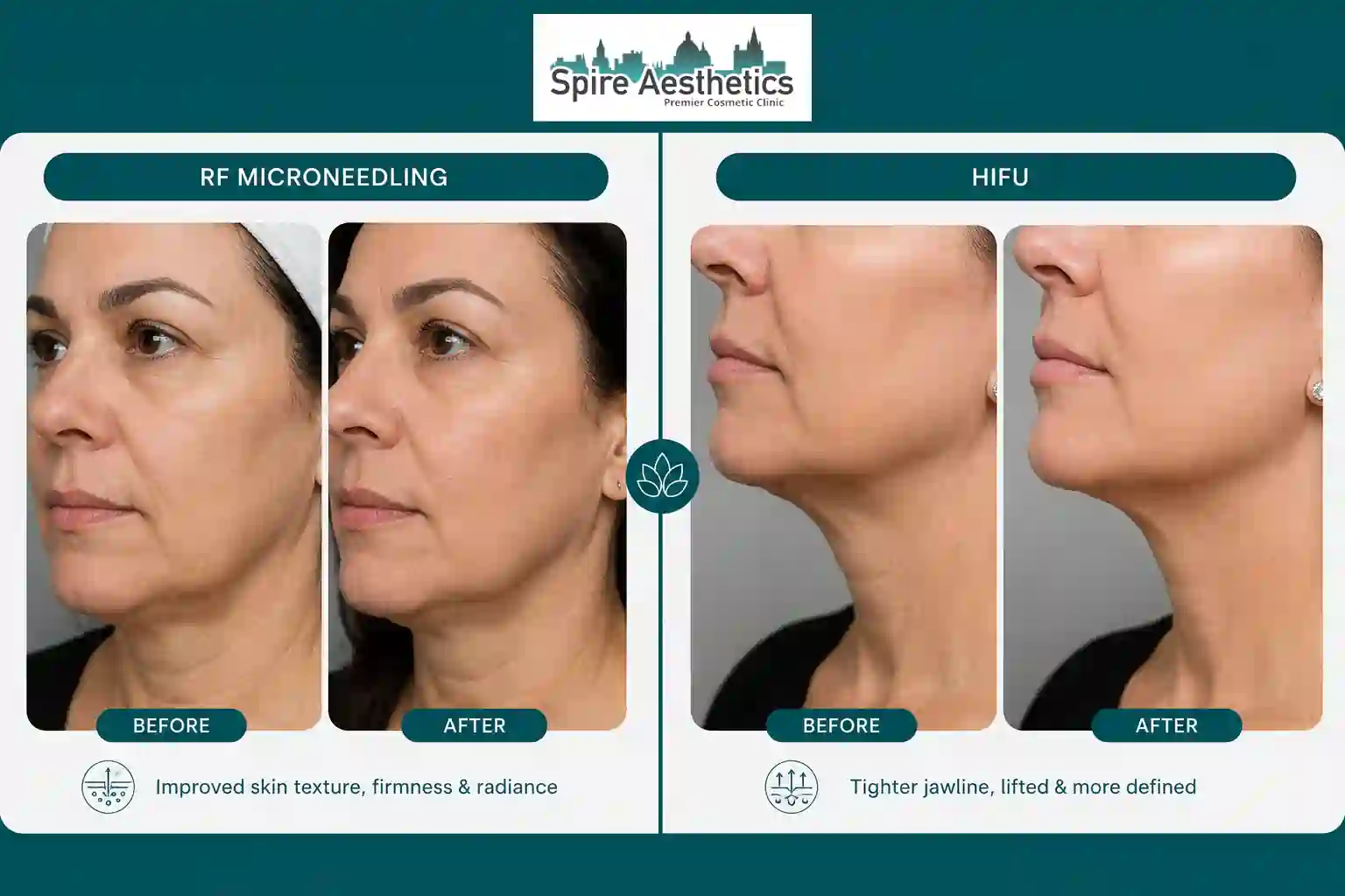 Can RF Microneedling and HIFU Be Combined Datchet?