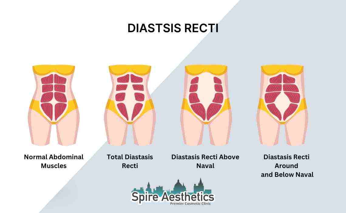 Is Non-Surgical Diastasis Recti Treatment Right for You? Common Concerns Answered Datchet
